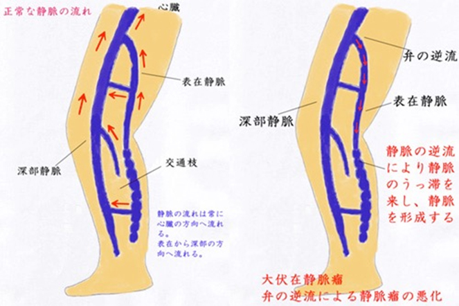 下肢静脈瘤