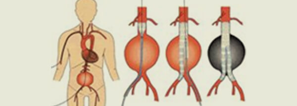 腹部・胸部大動脈瘤治療