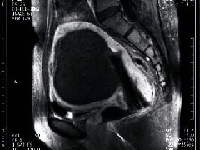 塞栓術治療3日後