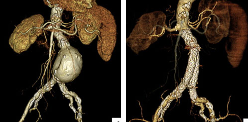 腹部大動脈瘤CT