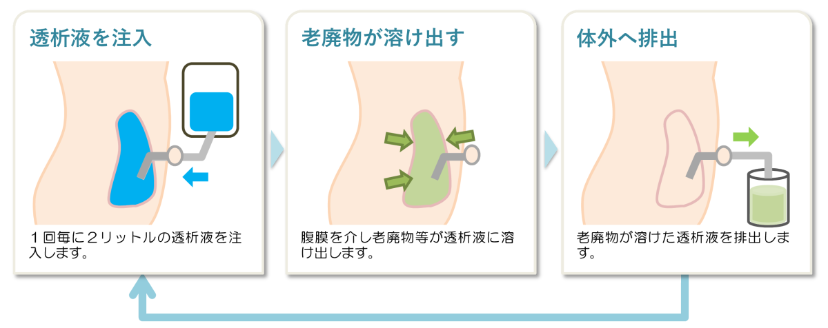 腹膜透析の流れ